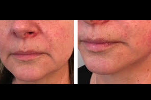 non-surgical-facelift-patient-10