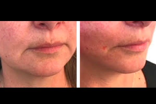 non-surgical-facelift-patient-10a