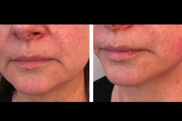 non-surgical-facelift-patient-10b