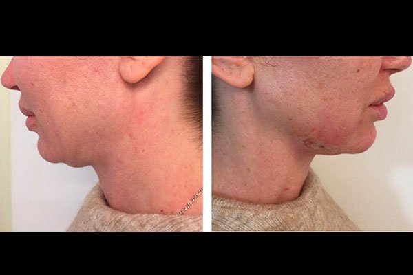 non-surgical-facelift-patient-4