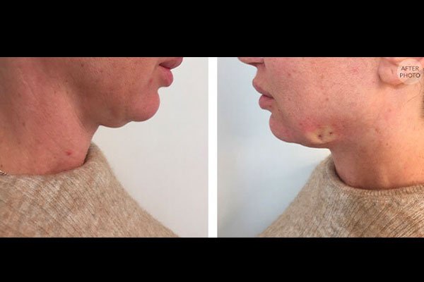 non-surgical-facelift-patient-5